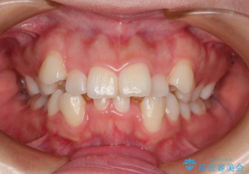 目立たない裏側矯正　抜歯矯正で口元を改善の症例 治療前
