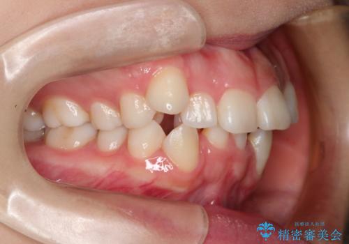 目立たない裏側矯正 抜歯矯正で口元を改善の治療前