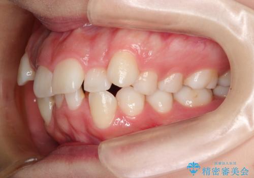 目立たない裏側矯正 抜歯矯正で口元を改善の治療前