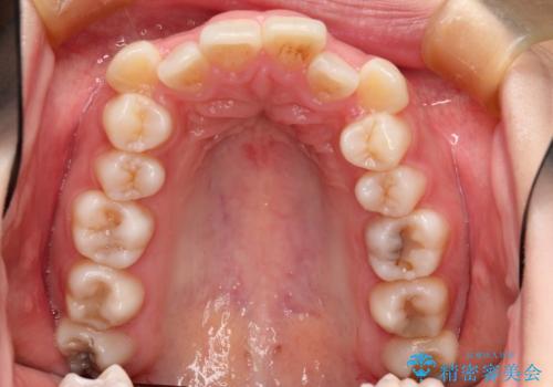 目立たない裏側矯正 抜歯矯正で口元を改善の治療前
