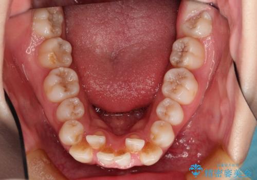 目立たない裏側矯正 抜歯矯正で口元を改善の治療前