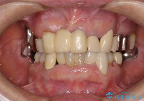 着色が著しい前歯のブリッジをオールセラミックできれいにの治療前