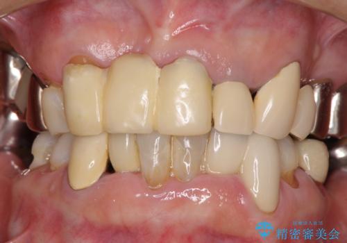 着色が著しい前歯のブリッジをオールセラミックできれいにの治療前