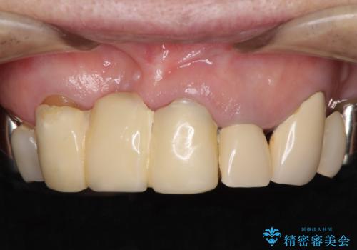 着色が著しい前歯のブリッジをオールセラミックできれいにの症例 治療前