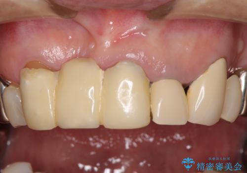 着色が著しい前歯のブリッジをオールセラミックできれいにの治療前