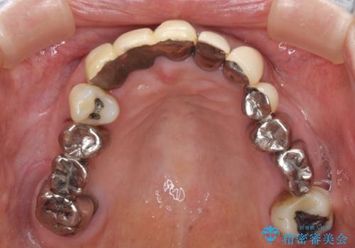 着色が著しい前歯のブリッジをオールセラミックできれいにの治療前