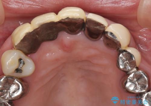 着色が著しい前歯のブリッジをオールセラミックできれいにの治療前