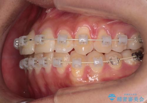 抜かない矯正　審美装置によるワイヤー治療の治療中