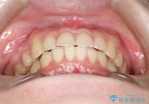 ワイヤーによる抜歯矯正　全体的なガタガタを整った歯並びへの治療後