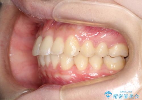 ワイヤーによる抜歯矯正　全体的なガタガタを整った歯並びへの症例 治療後