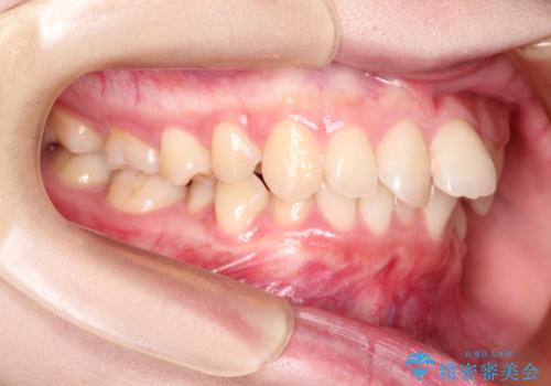 ワイヤーによる抜歯矯正　全体的なガタガタを整った歯並びへの治療前