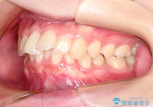 ワイヤーによる抜歯矯正　全体的なガタガタを整った歯並びへの症例 治療前
