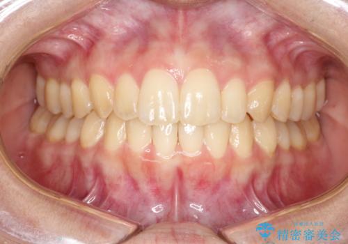 出ている前歯をインビザラインにて引っ込めるの治療後