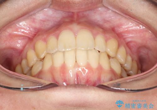 出ている前歯をインビザラインにて引っ込めるの治療後