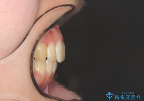 出ている前歯をインビザラインにて引っ込めるの治療後