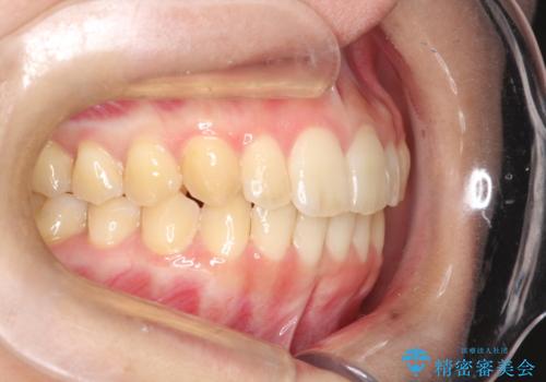 出ている前歯をインビザラインにて引っ込めるの治療後