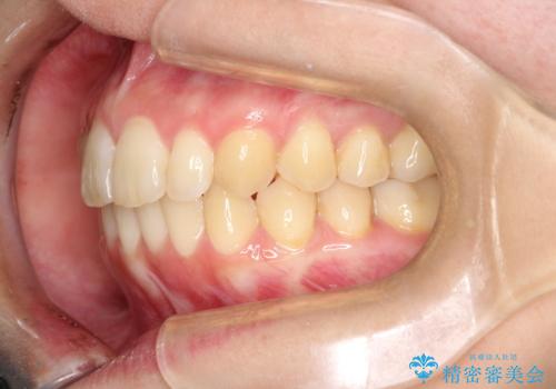 出ている前歯をインビザラインにて引っ込めるの症例 治療後