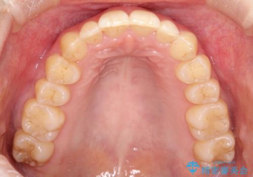 出ている前歯をインビザラインにて引っ込めるの治療後
