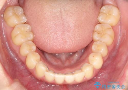 出ている前歯をインビザラインにて引っ込めるの治療後