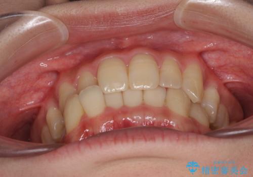 奥歯の反対咬合 上顎骨を拡大してインビザラインで矯正の治療前