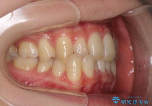 奥歯の反対咬合 上顎骨を拡大してインビザラインで矯正の治療前