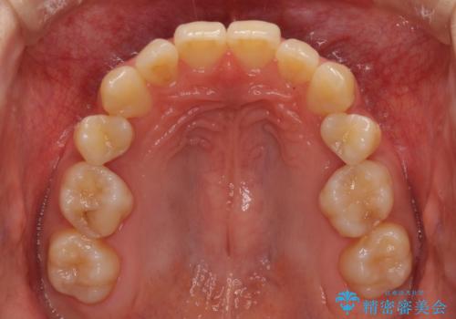 奥歯の反対咬合 上顎骨を拡大してインビザラインで矯正の治療前