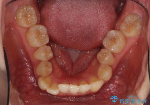 奥歯の反対咬合 上顎骨を拡大してインビザラインで矯正の治療前