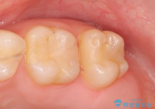 セラミックインレー　銀歯の下の縁下カリエス(歯茎より深い虫歯)の治療の治療前