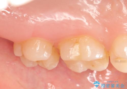 セラミックインレー 銀歯の下の縁下カリエス(歯茎より深い虫歯)の治療の治療前