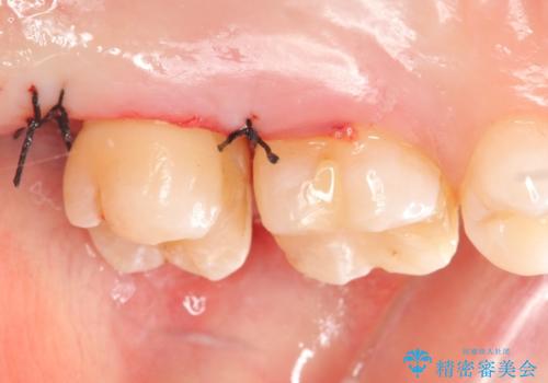 セラミックインレー 銀歯の下の縁下カリエス(歯茎より深い虫歯)の治療の治療後