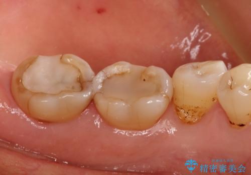 奥歯の被せ物をしたい。しみる奥歯、アイスを食べたい。の治療前