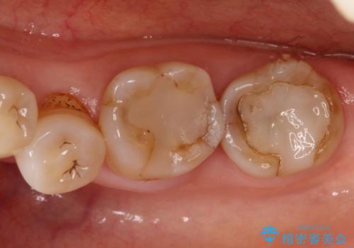 奥歯の被せ物をしたい。しみる奥歯、アイスを食べたい。の治療前