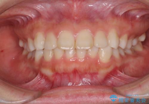 インビザラインによる軽度な出っ歯の矯正治療の症例 治療前