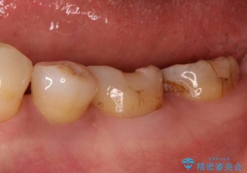 奥歯の被せ物をしたい。しみる奥歯、アイスを食べたい。の治療前