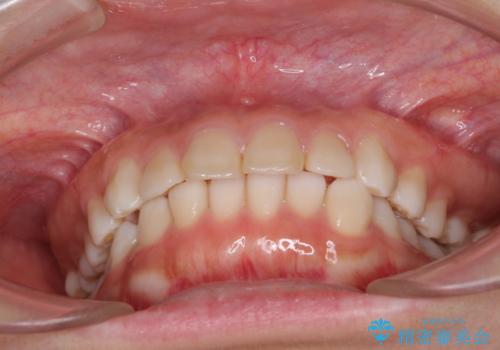 インビザラインによる軽度な出っ歯の矯正治療の治療前