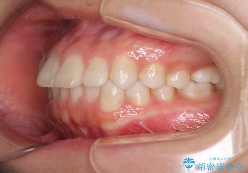 インビザラインによる軽度な出っ歯の矯正治療の治療前