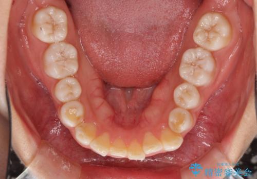 インビザラインによる軽度な出っ歯の矯正治療の治療前