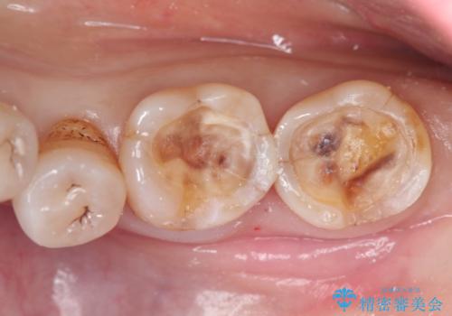 奥歯の被せ物をしたい。しみる奥歯、アイスを食べたい。の治療中