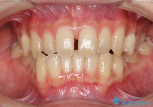 奥歯の反対咬合 上顎骨を拡大してインビザラインで矯正の治療中