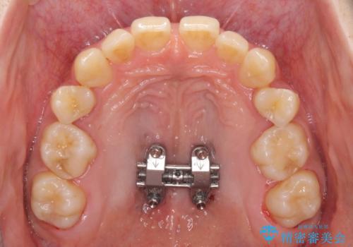 奥歯の反対咬合 上顎骨を拡大してインビザラインで矯正の治療中