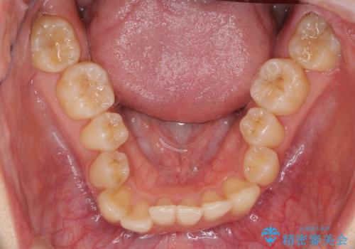 奥歯の反対咬合 上顎骨を拡大してインビザラインで矯正の治療中