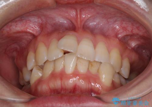 インビザラインで機能面に問題のある歯列を改善の治療前