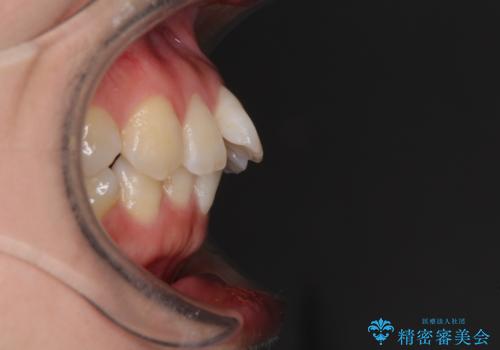 インビザラインで機能面に問題のある歯列を改善の治療前