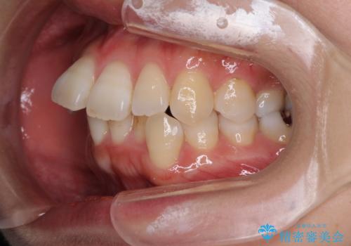 インビザラインで機能面に問題のある歯列を改善の治療前