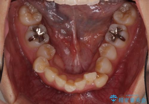 インビザラインで機能面に問題のある歯列を改善の治療前