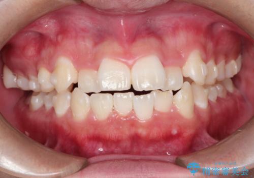 前歯のガタガタを目立たずきれいにしたい インビザラインによる見えない矯正の治療中