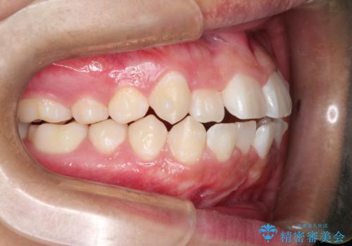 前歯のガタガタを目立たずきれいにしたい　インビザラインによる見えない矯正の治療中