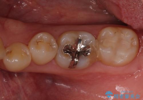 大きな虫歯で歯が欠けた　神経を極力残した治療の症例 治療前