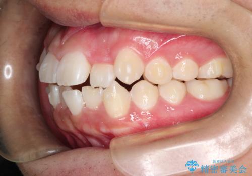 前歯のガタガタを目立たずきれいにしたい インビザラインによる見えない矯正の治療中