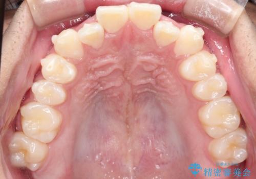前歯のガタガタを目立たずきれいにしたい インビザラインによる見えない矯正の治療中